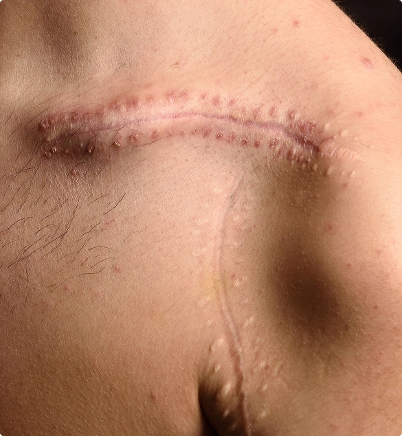 A man displaying a prominent scar across his chest, indicating a past injury or surgery.
