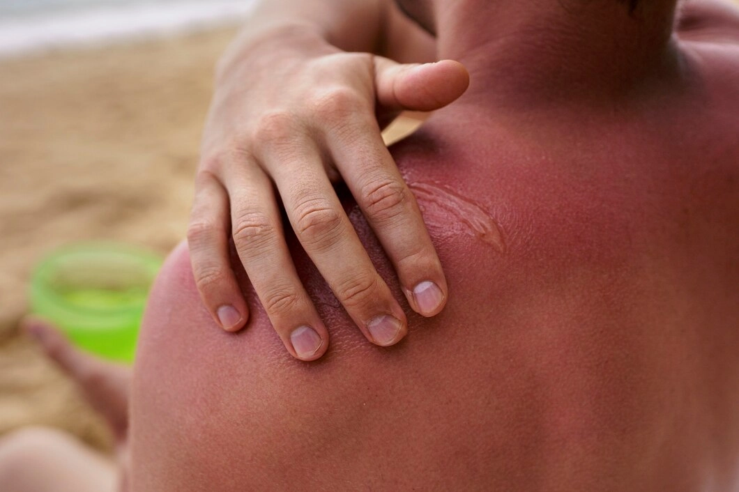 A man with a sunburned back stands on the beach, highlighting the effects of sun exposure on his skin.